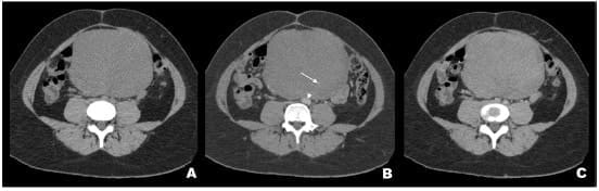 Tumor Desmoide Abdominal - estructuras vasculares en su interior 
