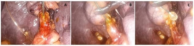 Extraccion transcistica de calculos en la via biliar utilizando un cateter Fogarty Extraccion transcistica de calculos en la via biliar utilizando un cateter Fogarty