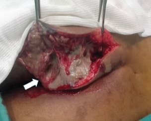 Femenina adulta joven, diabética, con proceso inflamatorio, necrótico y enfisematoso del glúteo izquierdo. Femenina adulta joven, diabética, con proceso inflamatorio, necrótico y enfisematoso del glúteo izquierdo.