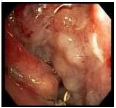 Cavidad de la fístula abordada con el endoscopio Cavidad de la fístula abordada con el endoscopio
