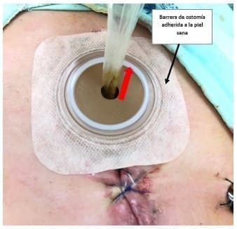 Fístulas por principio de
capilaridad.