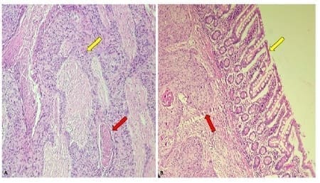 Fotomicrografía que muestran una neoplasia maligna Fotomicrografía que muestran una neoplasia maligna