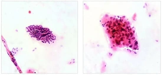 Groups of follicular cells with nuclear crowding Groups of follicular cells with nuclear crowding