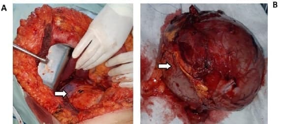 Hallazgo quirúrgico tumor resecado Hallazgo quirúrgico tumor resecado