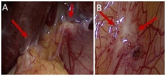 Hallazgos laparoscópicos de compromiso peritoneal por cáncer de vesícula Hallazgos laparoscópicos de compromiso peritoneal por cáncer de vesícula