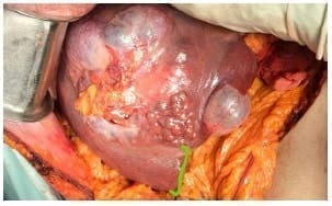 Hepatocarcinoma, hígado sin aspecto cirrótico Hepatocarcinoma, hígado sin aspecto cirrótico
