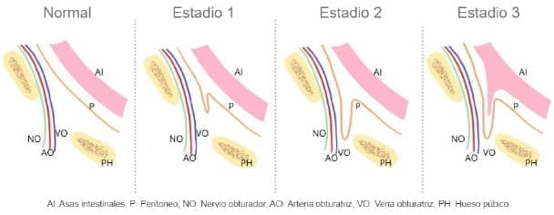 Fisiopatología de la hernia obturatriz Fisiopatología de la hernia obturatriz