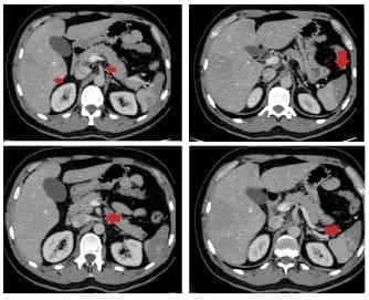 Infartos esplénicos y trastorno de la perfusión hepática