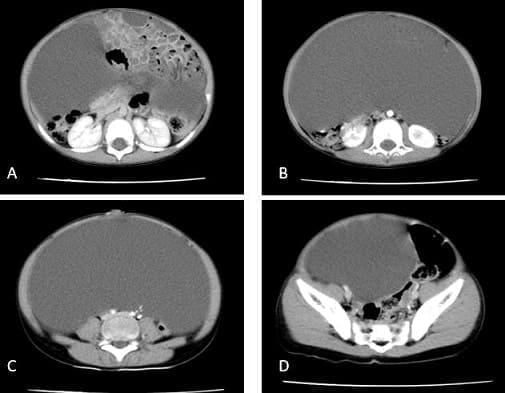 Lesión quística gigante con desplazamiento de asas intestinales Lesión quística gigante con desplazamiento de asas intestinales