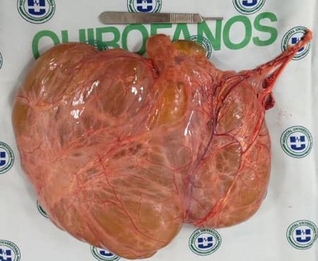 Pieza quirúrgica. Lesión de aspecto quístico pediculada - Quiste Mesentérico Gigante Pieza quirúrgica. Lesión de aspecto quístico pediculada - Quiste Mesentérico Gigante