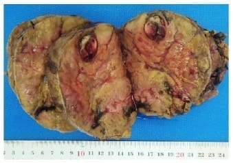 Aspecto macroscópico: lesión sólida - Feocromocitoma Adrenal Aspecto macroscópico: lesión sólida - Feocromocitoma Adrenal
