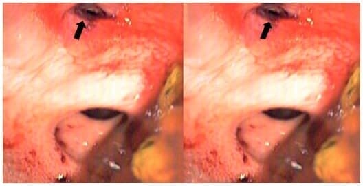 Lesión traumática con bordes necróticos, irregulares