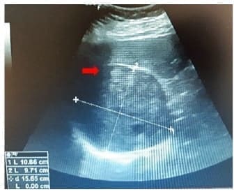 Lesión tumoral en glándula suprarrenal derecha Lesión tumoral en glándula suprarrenal derecha