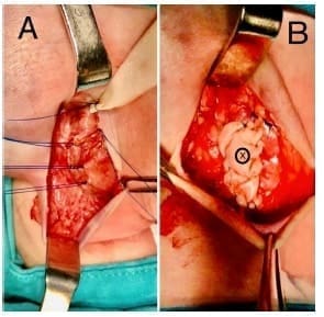 Síndrome Lumbocostovertebral - Aspectos de la cirugía