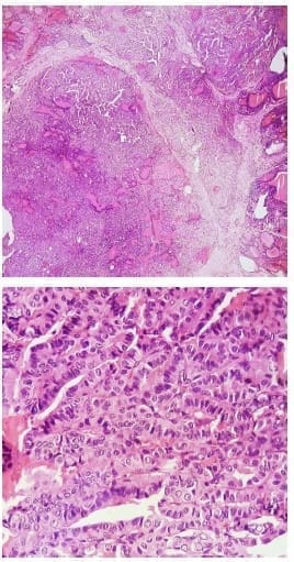 The sections show a malignant epithelial lesion - Nódulos Calientes en Pacientes con Hipertiroidismo The sections show a malignant epithelial lesion - Nódulos Calientes en Pacientes con Hipertiroidismo
