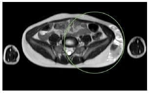 Masa que deforma la pared lateral del flanco y el lado izquierdo de la pelvis Masa que deforma la pared lateral del flanco y el lado
izquierdo de la pelvis