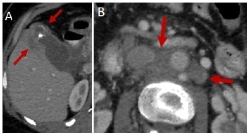 Masa en el fondo de la vesícula Masa en el fondo de la vesícula