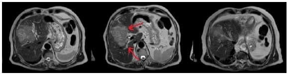 Masa hepática - Mesohepatectomía Masa hepática - Mesohepatectomía
