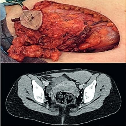 Masa resecada, en la parte inferior se observa la resonancia - Fibromatosis Agresiva