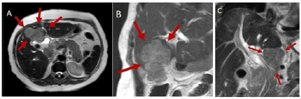 Masa en la vesícula biliar con infiltración al hígado Masa en la vesícula biliar con infiltración al hígado