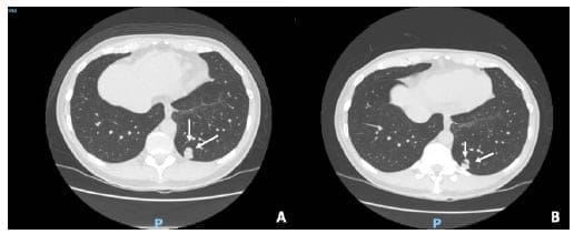 Paciente en seguimiento de nódulo pulmonar