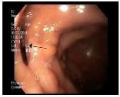 Gran orificio fistuloso a la izquierda Gran orificio fistuloso a la izquierda