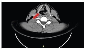Cuello con evidencia de disrupción de la pared laríngea a nivel del hioides Cuello con evidencia
de disrupción de la pared laríngea a nivel del hioides