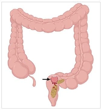 Paso de las heces lesiona la mucosa friable del pólipo Paso de las heces lesiona la mucosa friable del pólipo