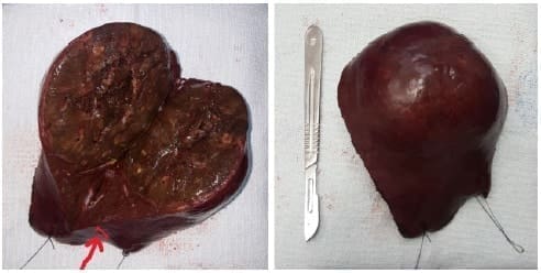 Pieza quirúrgica producto de mesohepatectomía Pieza quirúrgica producto de mesohepatectomía