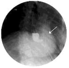 Medio de contraste pasando a la pleura a través de la fistula Medio de contraste pasando a la pleura a través de la fistula