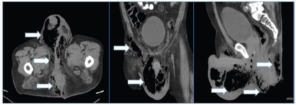 Proceso inflamatorio enfisematoso que afecta la región perianal, genital, glútea e inguinal derecha Proceso inflamatorio enfisematoso que afecta la región
perianal, genital, glútea e inguinal derecha