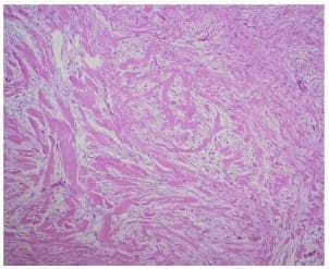 Proliferación mesenquimática entremezclada con gruesos haces de colágeno Proliferación mesenquimática entremezclada con gruesos haces de colágeno