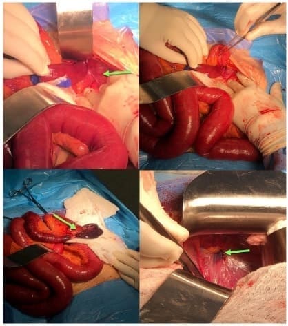 Reducción del asa intestinal delgada estrangulada Reducción del asa intestinal delgada estrangulada