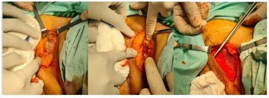 Reparo del defecto herniario con malla por un abordaje externo Reparo del defecto herniario con malla por un abordaje externo