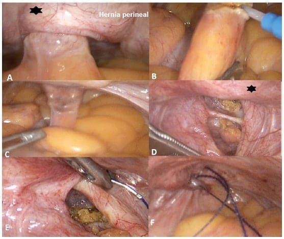 Reparo laparoscópico de la hernia perineal Reparo laparoscópico de la hernia perineal