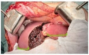 Resección hepática de sectores centrales medial izquierdo y anterior derecho Resección hepática de sectores centrales medial izquierdo y anterior derecho