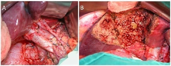 Resección radical por cáncer de vesícula biliar Resección radical por cáncer de vesícula biliar
