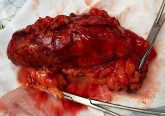 Pieza de resección de segmento de colon transverso Pieza de resección de segmento de colon transverso