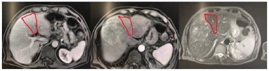 Resonancia nuclear magnética de abdomen. Se observa un hepatocarcinoma Resonancia nuclear magnética de abdomen. Se observa un hepatocarcinoma