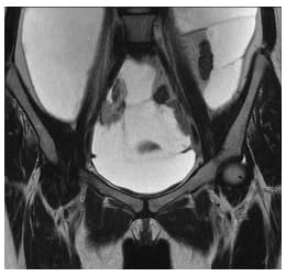 Origen del primer quiste en la trompa de Falopio derecha Origen del primer quiste en la trompa de Falopio derecha