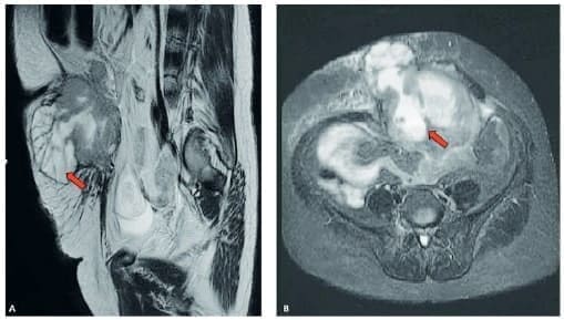 Resonancia magnética nuclear en la región abdominopélvica de la paciente Resonancia magnética nuclear en la región abdominopélvica de la paciente