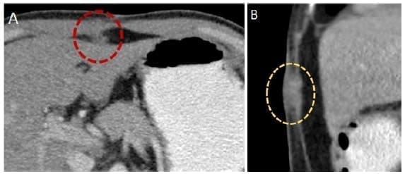 Siembras tumorales en la pared abdominal Siembras tumorales en la pared abdominal