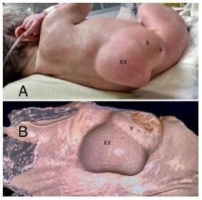 Síndrome Lumbocostovertebral - Tumoración