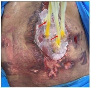 Técnica de manejo de fístulas por principio de capilaridad