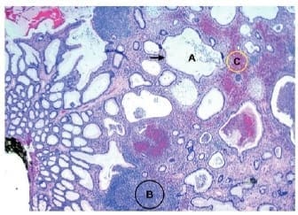 Tinción de hematoxilina-eosina 4X, dilatación quística glandular Tinción de hematoxilina-eosina 4X, dilatación quística glandular