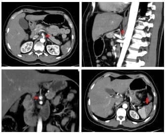 Tronco celíaco
autolimitada en la arteria hepática común