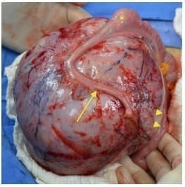 Tumor Desmoide Abdominal - Mesenterio íntimamente adherido al apéndice cecal Tumor Desmoide Abdominal - Mesenterio íntimamente adherido al apéndice cecal