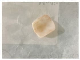 Hallazgo intraoperatorio de un cuerpo extraño (uña artificial).