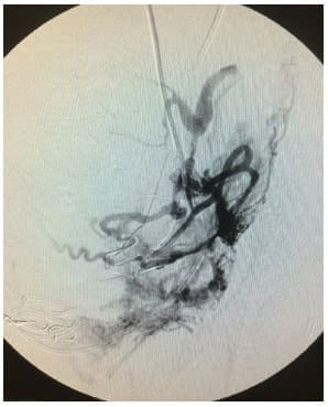 Vasos pseudotumorales anomalos y multiples que nutren la placenta percreta Vasos pseudotumorales anomalos y multiples que nutren la placenta percreta