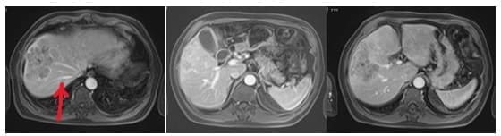 vena suprahepática derecha Hepatocarcinoma - vena suprahepática derecha